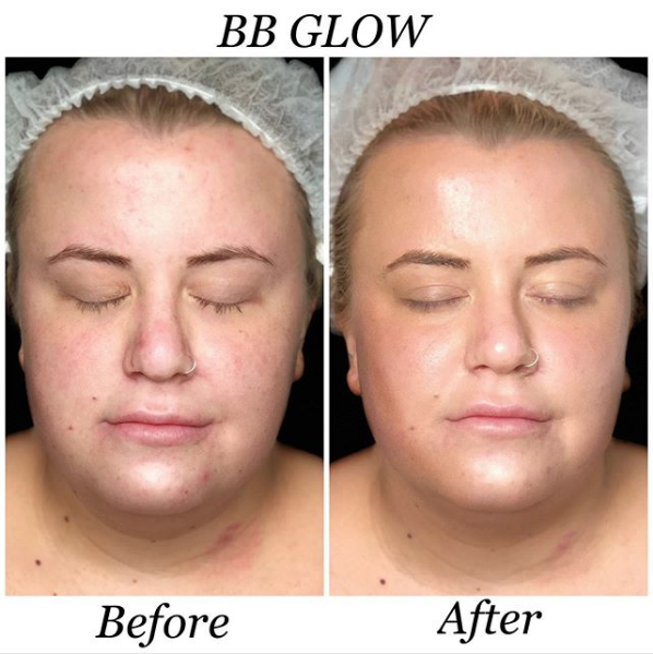 BB Glow: o tratamento que deixa a pele com efeito de base.
As mulheres brasileiras têm incorporado cada vez mais técnicas pertencentes à rotina de beleza coreana. E a novidade estética do momento é a BB Glow, uma espécie de maquiagem…Continue lendo…